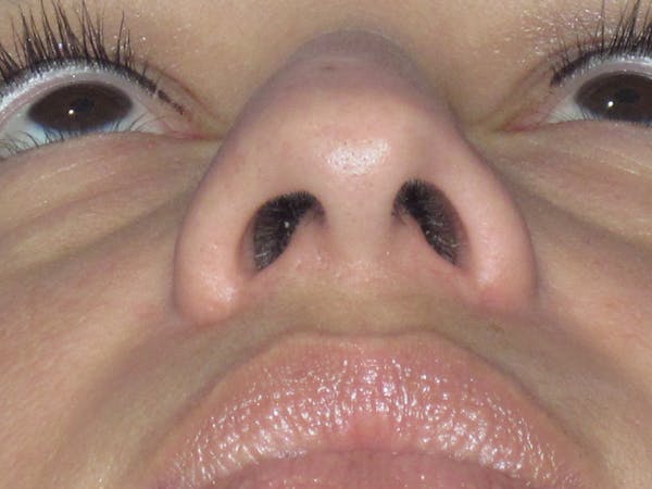 Rhinoplasty Before & After Gallery - Patient 391656 - Image 11