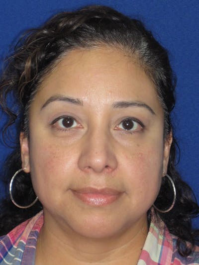 Rhinoplasty Before & After Gallery - Patient 391656 - Image 4