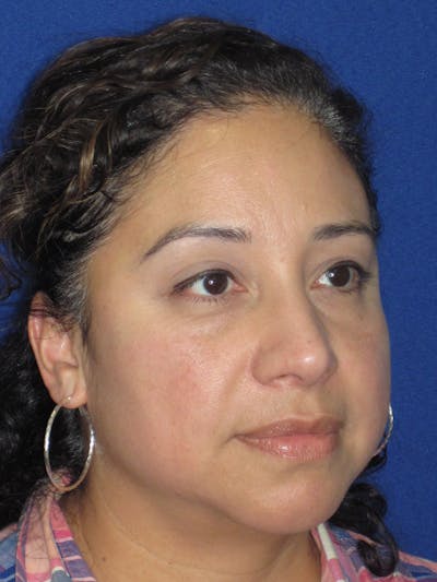 Rhinoplasty Before & After Gallery - Patient 391656 - Image 6