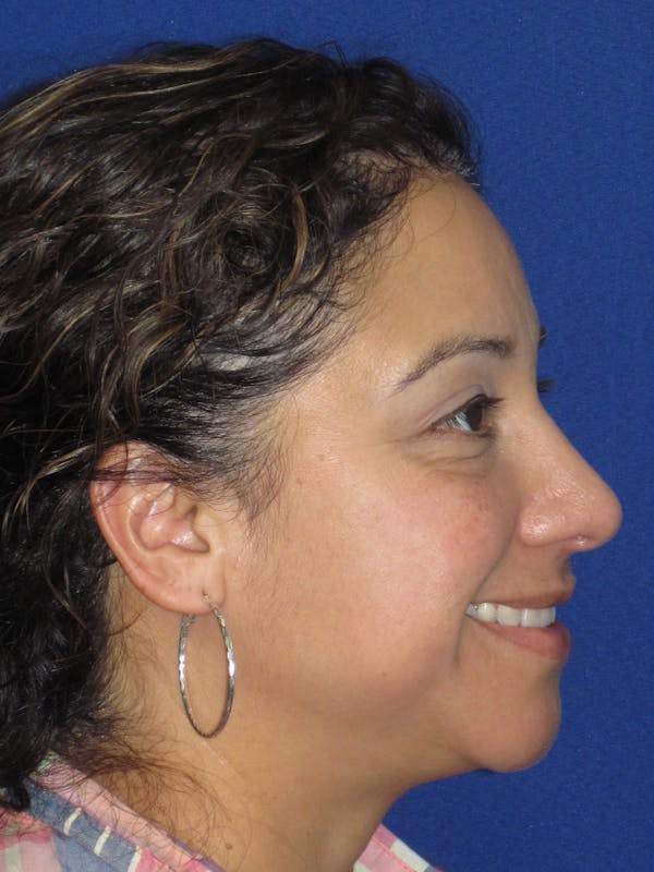 Rhinoplasty Before & After Gallery - Patient 391656 - Image 8