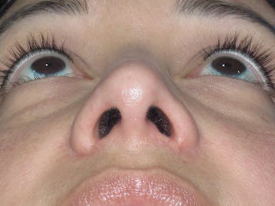 Rhinoplasty Before & After Gallery - Patient 391656 - Image 12