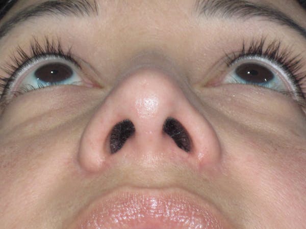 Rhinoplasty Before & After Gallery - Patient 391656 - Image 12