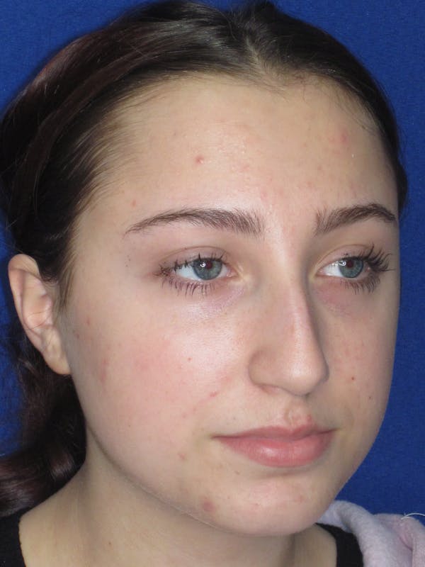 Rhinoplasty Before & After Gallery - Patient 241667 - Image 5