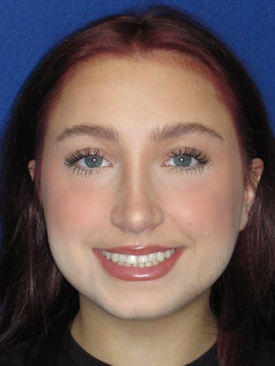 Rhinoplasty Before & After Gallery - Patient 241667 - Image 4