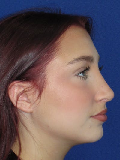Rhinoplasty Before & After Gallery - Patient 241667 - Image 8