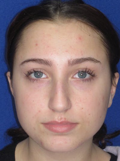 Rhinoplasty Before & After Gallery - Patient 241667 - Image 1