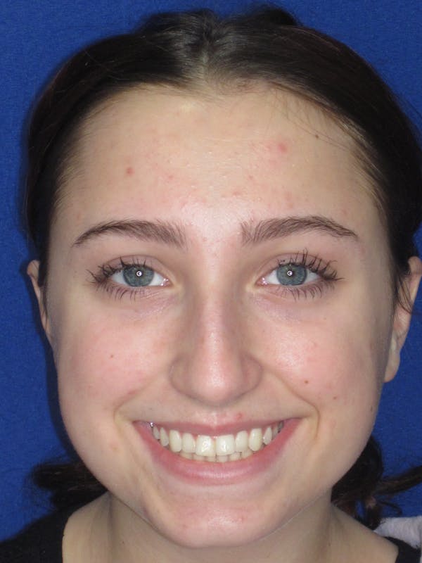 Rhinoplasty Before & After Gallery - Patient 241667 - Image 3