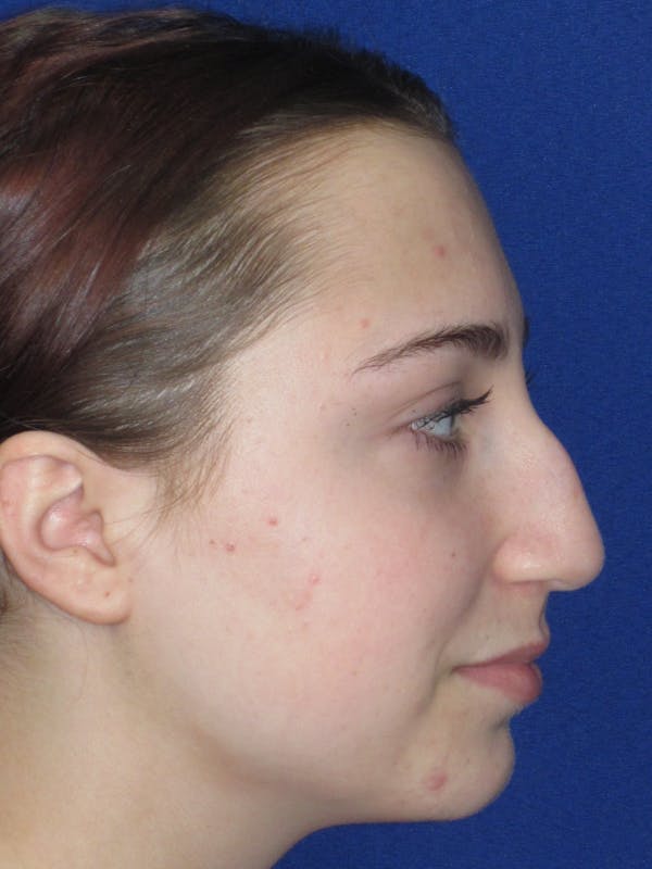 Rhinoplasty Before & After Gallery - Patient 241667 - Image 7