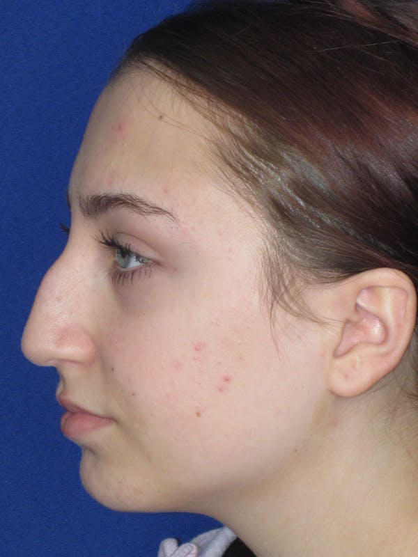Rhinoplasty Before & After Gallery - Patient 241667 - Image 13