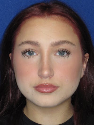 Rhinoplasty Before & After Gallery - Patient 241667 - Image 2
