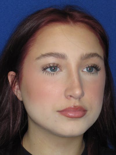 Rhinoplasty Before & After Gallery - Patient 241667 - Image 6
