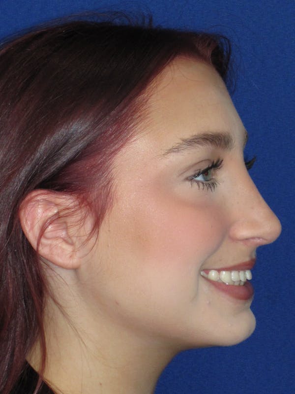 Rhinoplasty Before & After Gallery - Patient 241667 - Image 10