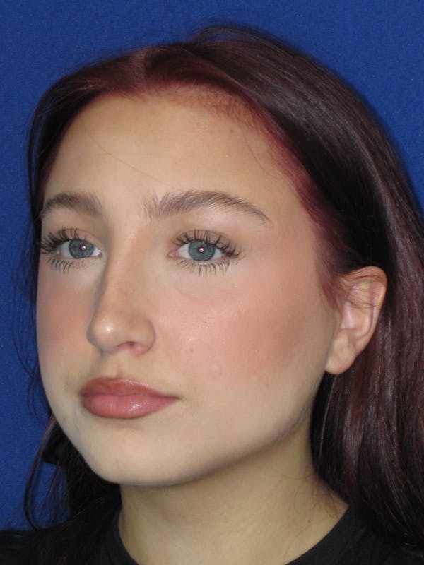 Rhinoplasty Before & After Gallery - Patient 241667 - Image 12