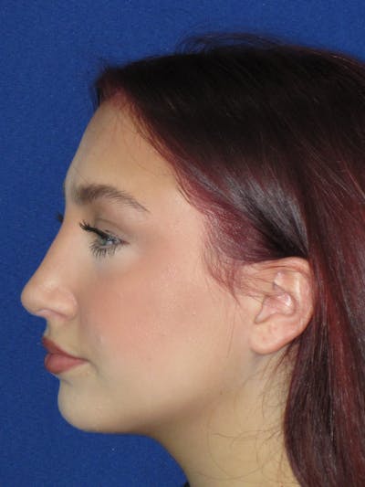 Rhinoplasty Before & After Gallery - Patient 241667 - Image 14