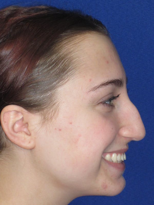 Rhinoplasty Before & After Gallery - Patient 241667 - Image 9