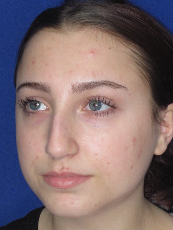 Rhinoplasty Before & After Gallery - Patient 241667 - Image 11