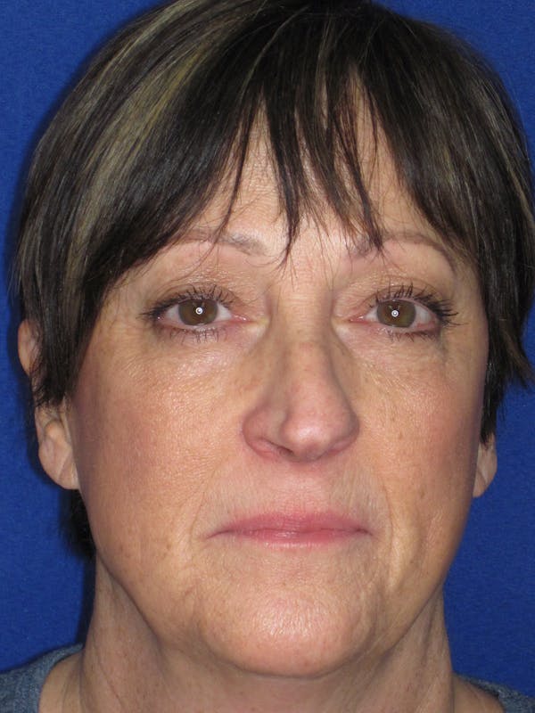 Rhinoplasty Before & After Gallery - Patient 305209 - Image 1