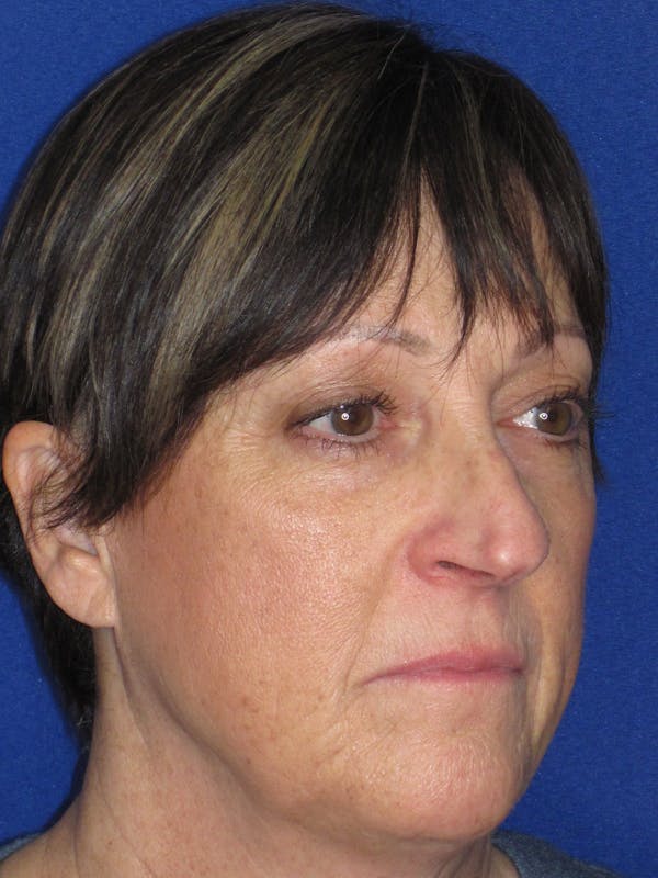 Rhinoplasty Before & After Gallery - Patient 305209 - Image 3
