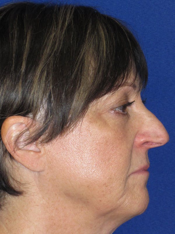Rhinoplasty Before & After Gallery - Patient 305209 - Image 5