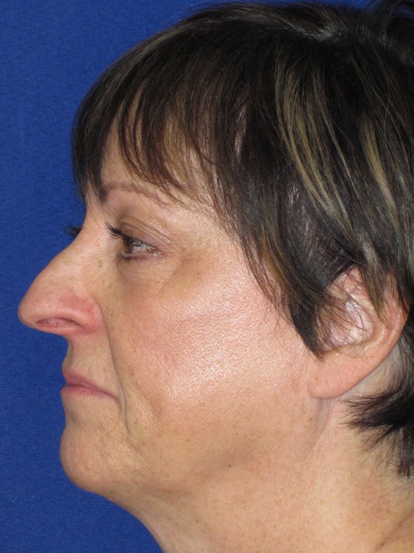 Rhinoplasty Before & After Gallery - Patient 305209 - Image 9