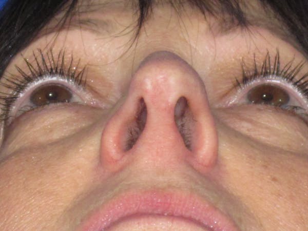 Rhinoplasty Before & After Gallery - Patient 305209 - Image 11
