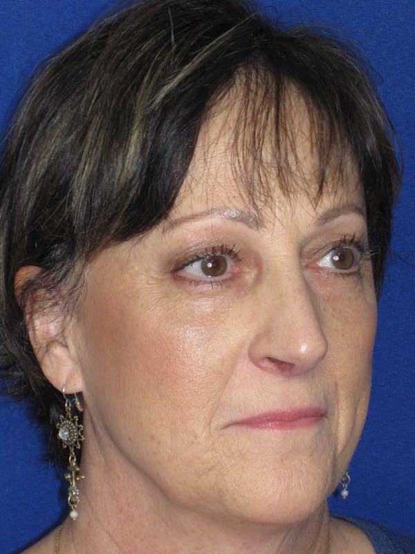 Rhinoplasty Before & After Gallery - Patient 305209 - Image 4