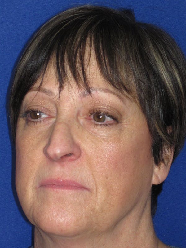 Rhinoplasty Before & After Gallery - Patient 305209 - Image 7