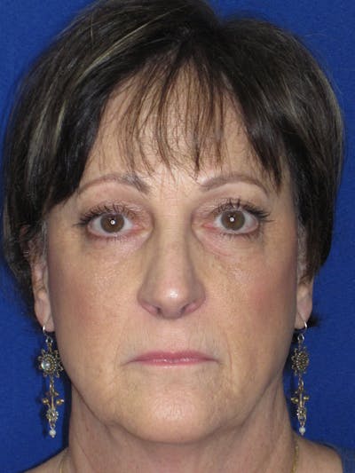 Rhinoplasty Before & After Gallery - Patient 305209 - Image 2