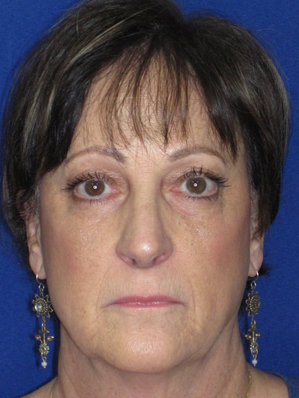 Rhinoplasty Before & After Gallery - Patient 305209 - Image 2