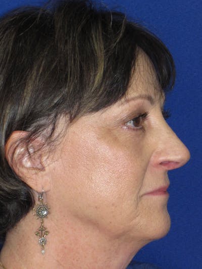 Rhinoplasty Before & After Gallery - Patient 305209 - Image 6
