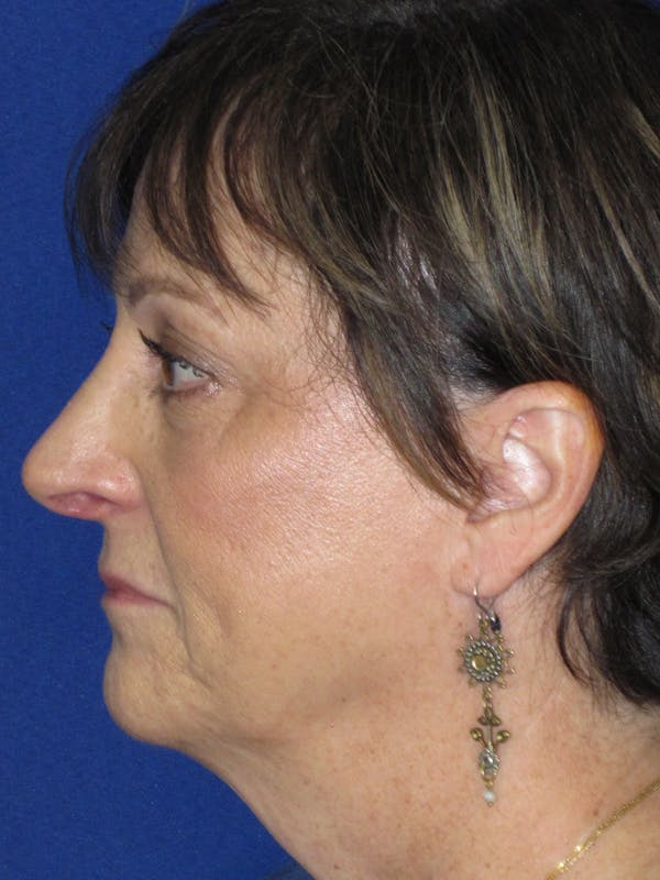 Rhinoplasty Before & After Gallery - Patient 305209 - Image 10
