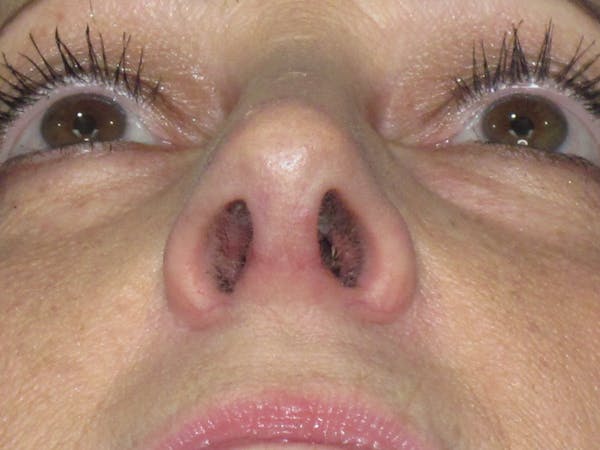 Rhinoplasty Before & After Gallery - Patient 305209 - Image 12
