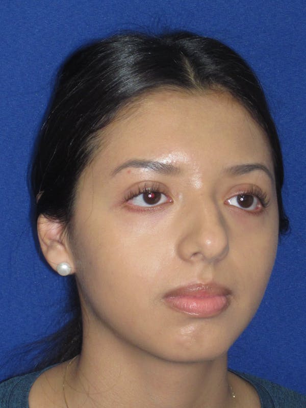 Rhinoplasty Before & After Gallery - Patient 535236 - Image 3