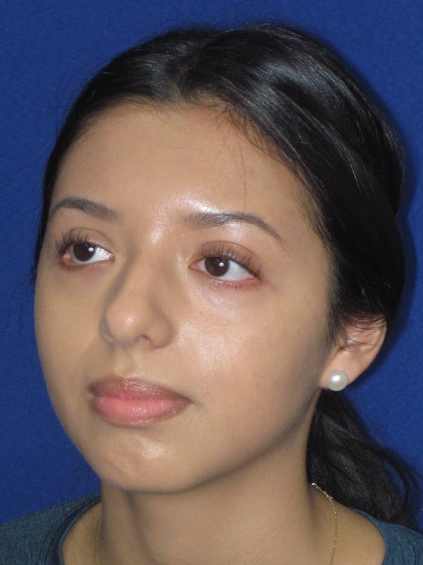 Rhinoplasty Before & After Gallery - Patient 535236 - Image 5