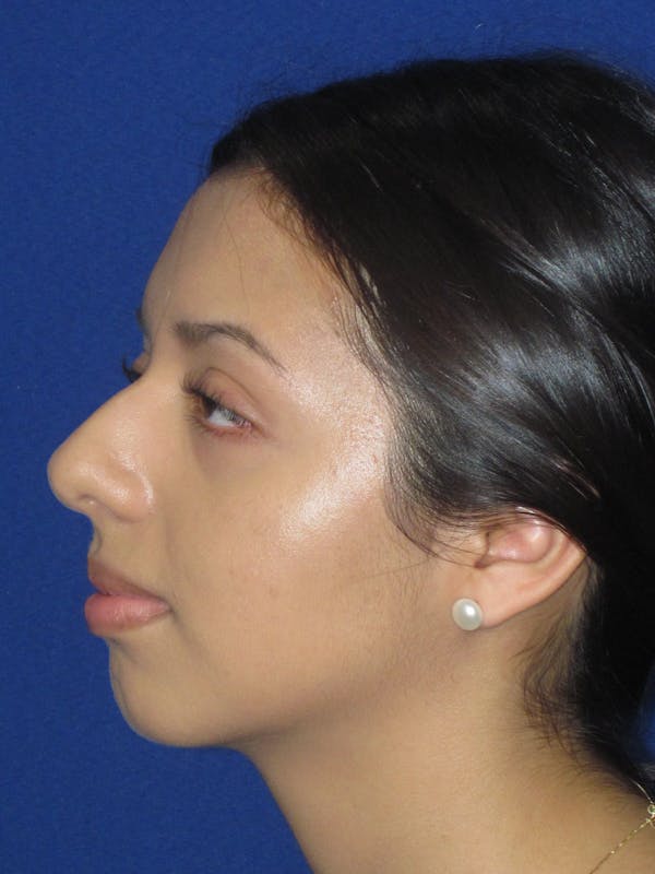 Rhinoplasty Before & After Gallery - Patient 535236 - Image 7