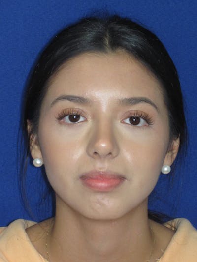 Rhinoplasty Before & After Gallery - Patient 535236 - Image 2