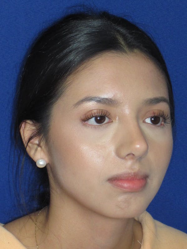 Rhinoplasty Before & After Gallery - Patient 535236 - Image 4