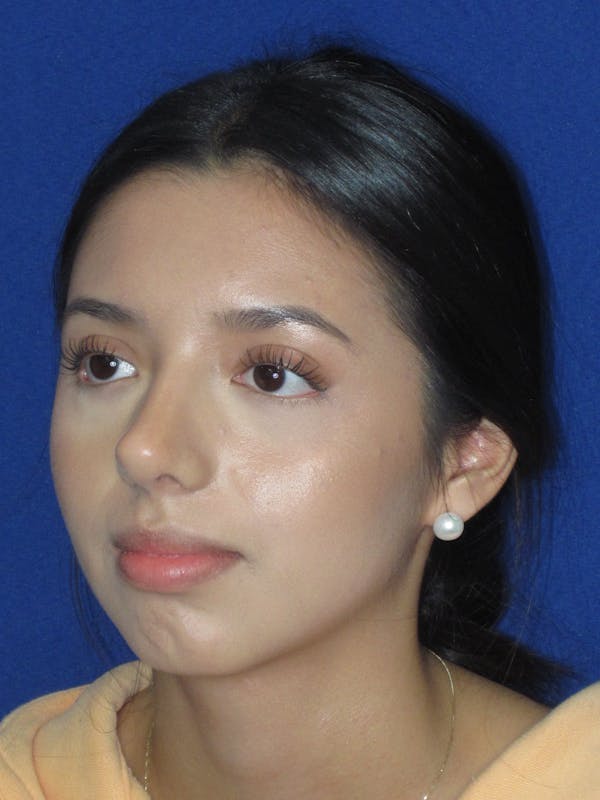 Rhinoplasty Before & After Gallery - Patient 535236 - Image 6