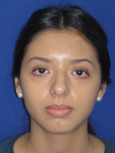 Rhinoplasty Before & After Gallery - Patient 535236 - Image 1