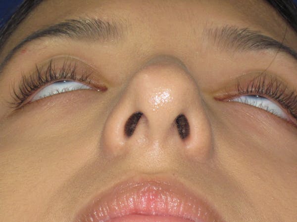 Rhinoplasty Before & After Gallery - Patient 535236 - Image 9