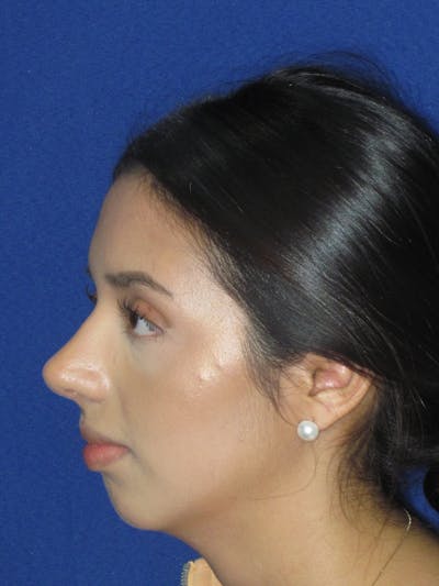 Rhinoplasty Before & After Gallery - Patient 535236 - Image 8