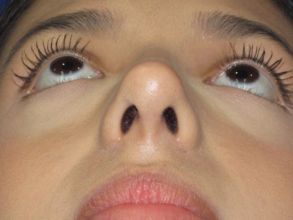 Rhinoplasty Before & After Gallery - Patient 535236 - Image 10