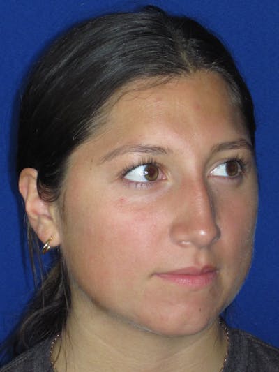 Rhinoplasty Before & After Gallery - Patient 139842 - Image 1