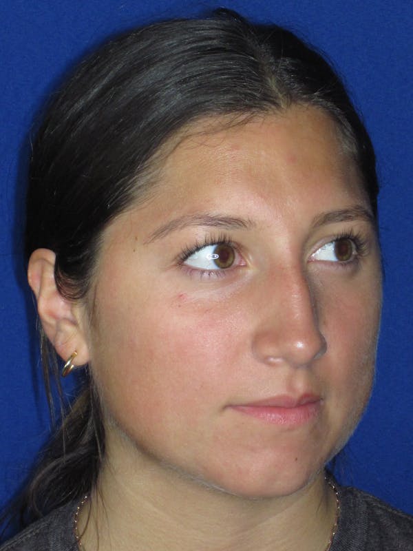 Rhinoplasty Before & After Gallery - Patient 139842 - Image 1