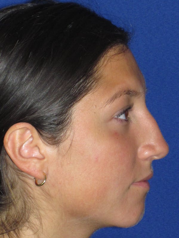 Rhinoplasty Before & After Gallery - Patient 139842 - Image 3