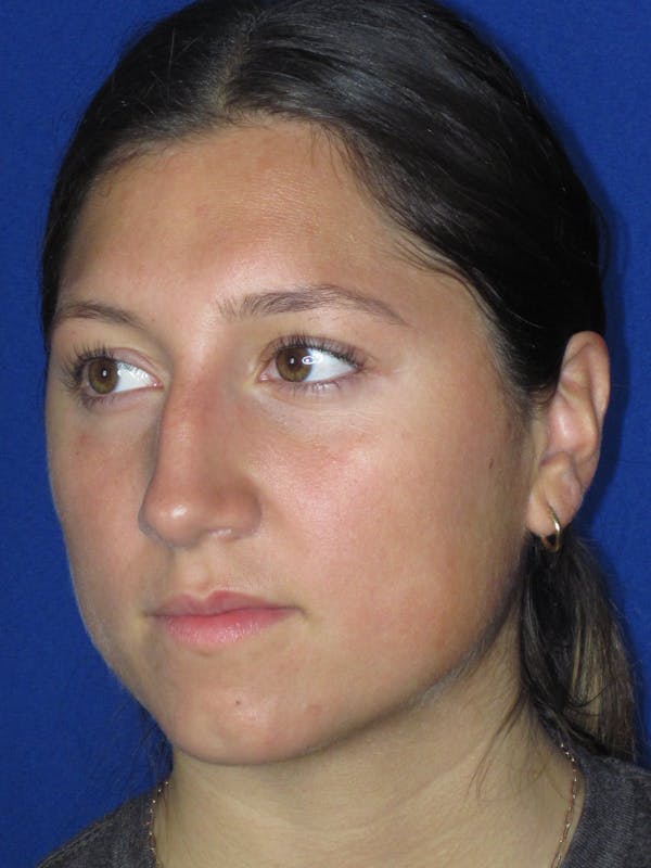 Rhinoplasty Before & After Gallery - Patient 139842 - Image 7