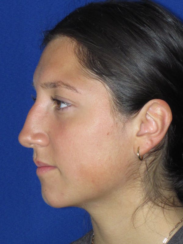 Rhinoplasty Before & After Gallery - Patient 139842 - Image 9