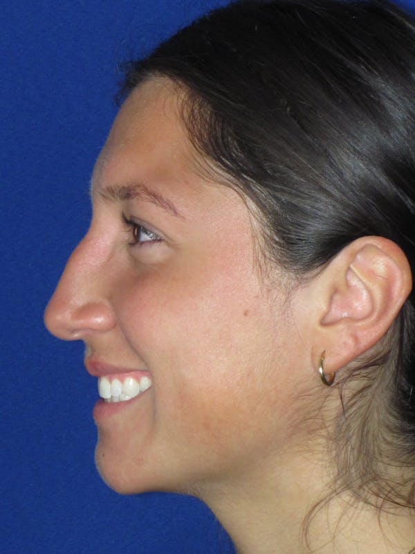 Rhinoplasty Before & After Gallery - Patient 139842 - Image 11