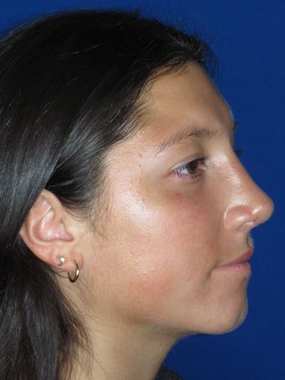 Rhinoplasty Before & After Gallery - Patient 139842 - Image 4