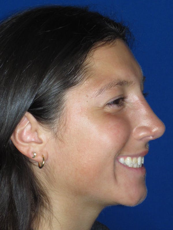 Rhinoplasty Before & After Gallery - Patient 139842 - Image 6